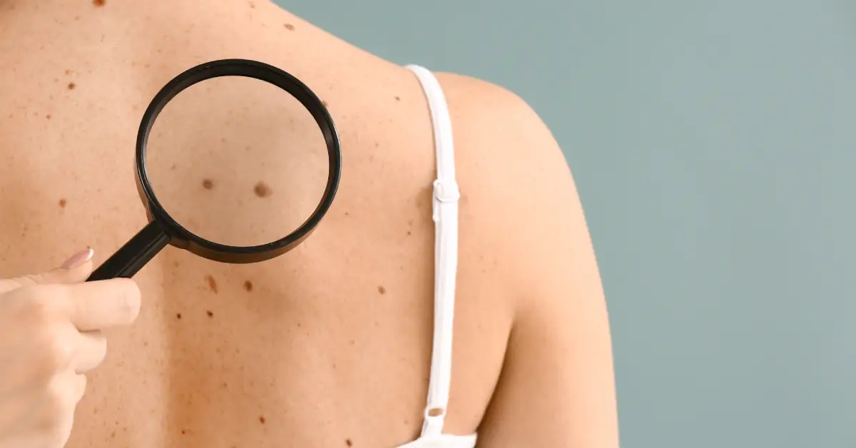 grain de beauté à surveiller pour prévenir le mélanome