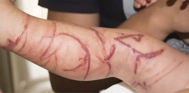 Lésions cutanées provoquées par une piqûre de méduse