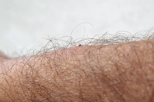 Tique fixée sur la peau d'une personne